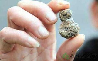 肾结石吃哪些瓜,这些瓜类食物助你排石养肾